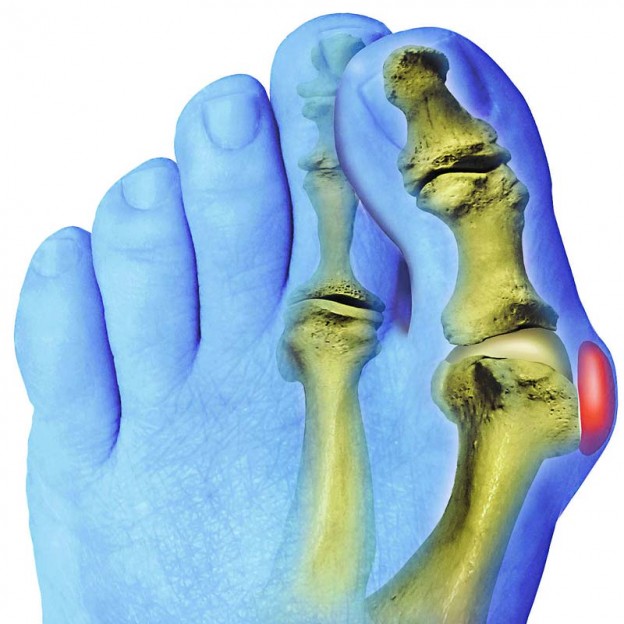 Фото - Терапия «косточек» больших пальцев ног